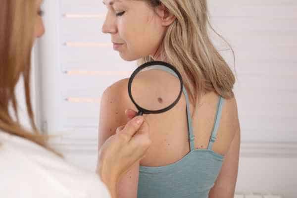 What Are Traditional Skin Lesion Removal Methods Kilburn?