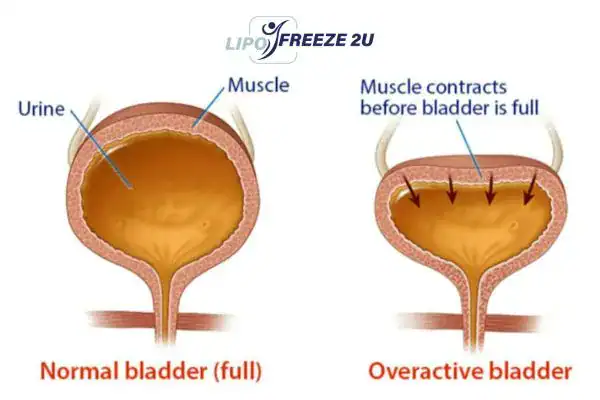 diagram of overactive bladder treatment Kilburn
