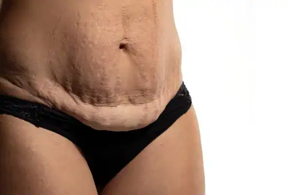 loose skin after weight loss injections Kilburn