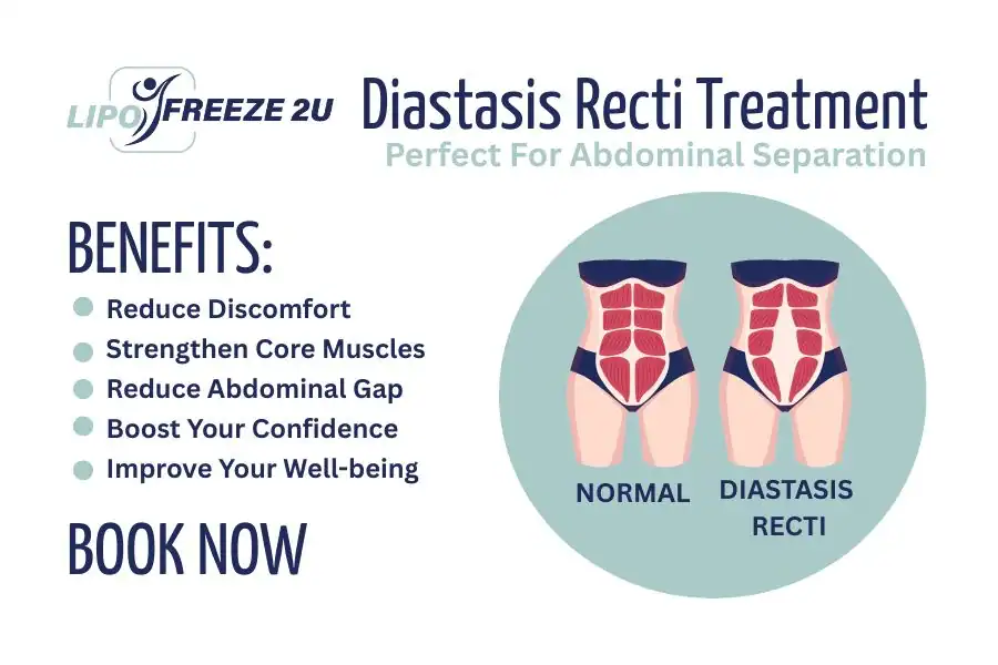 Benefits of body toning treatment Kilburn for Diastasis recti