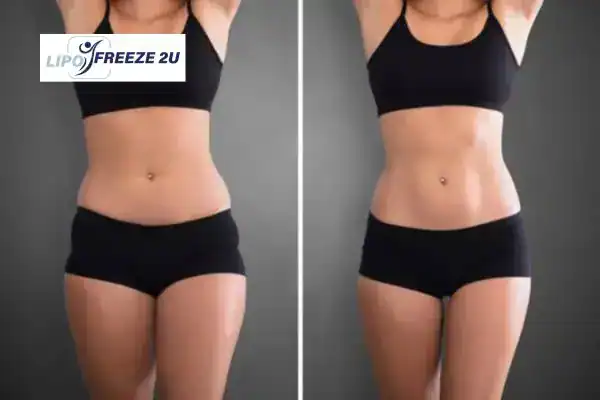 How Can LIPO FREEZE 2U Support Your Post-Pregnancy Body Recovery Kilburn?