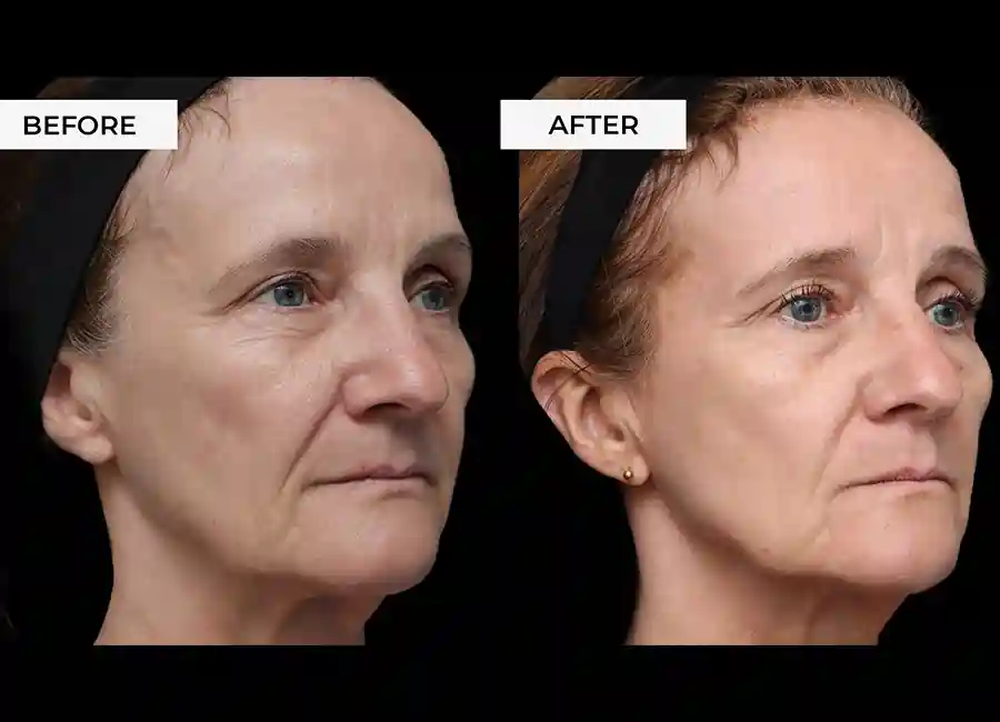 How Many RF Microneedling Sessions Will You Need to See a Difference Kilburn?