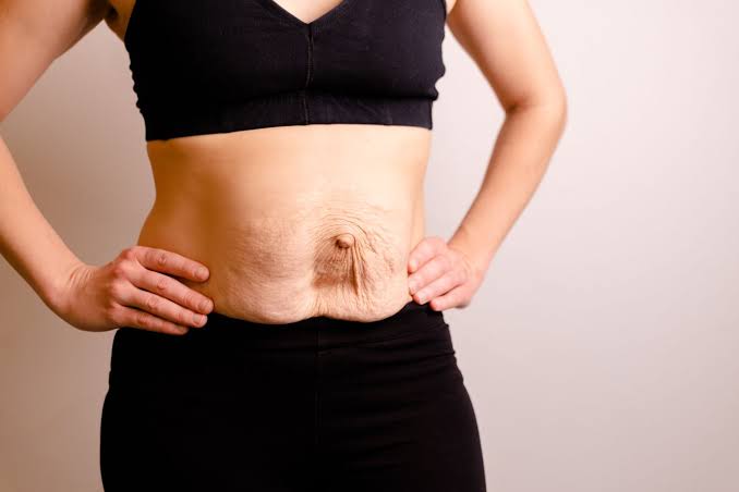 Is Surgery Really the Only Way to Repair Diastasis Recti Kilburn?