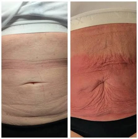 How Does RF Microneedling Improve Crepey, Thin and Uneven Skin Texture Kilburn?