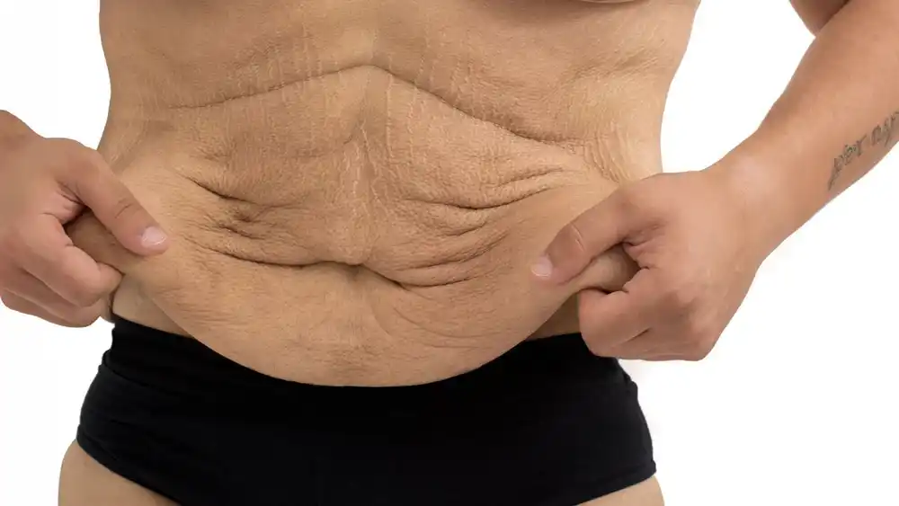 Why Does Weight Loss Medication Leave Some People With Loose or Sagging Skin Kilburn?